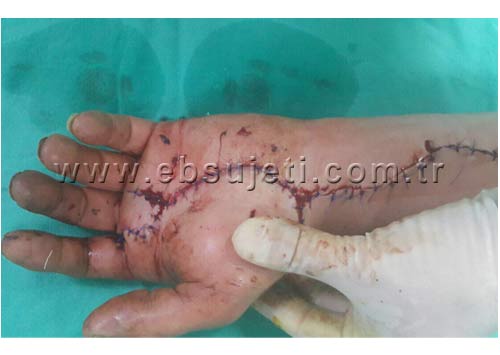 Water Jetting Accident Photos